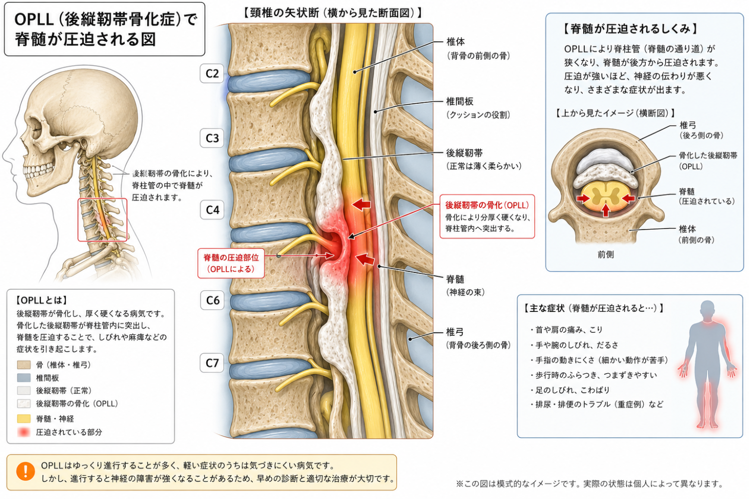 OPLL模式図