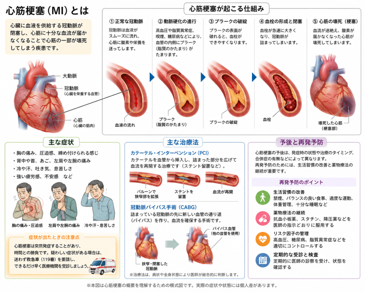 心筋梗塞模式図(ChatGPT)